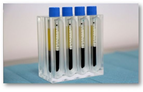 Endoret/ Эндорет – испанская плазмотерапия с уникальным протоколом выделения плазмы, обогащенной факторами роста (PRGF).